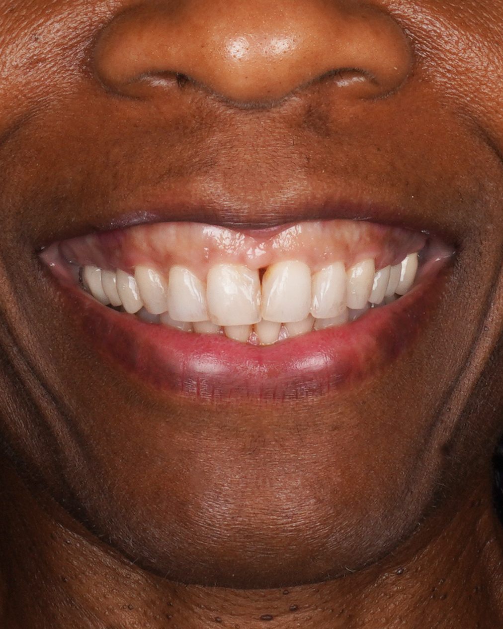 Porcelain Veneers — Before